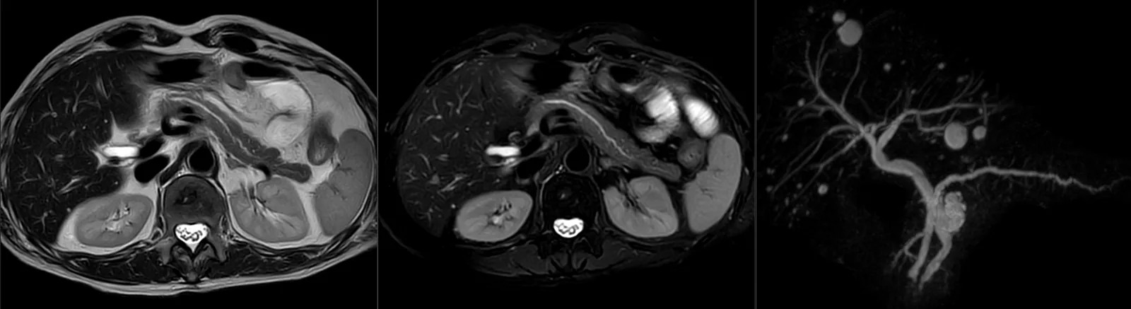 Ressonância magnética abdominal e colangio-RM: cortes axiais do abdómen superior — fígado, pâncreas, baço e rins — e uma reconstrução das vias biliares e do canal pancreático (CPRM).