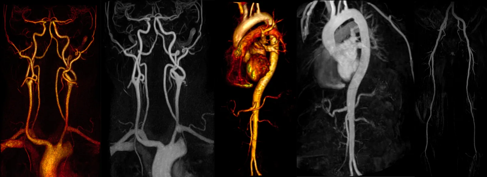 Angio-RM: reconstruções dos vasos intracranianos e cervicais e do território aórtico (arco aórtico e aorta torácica e abdominal), sem radiação.