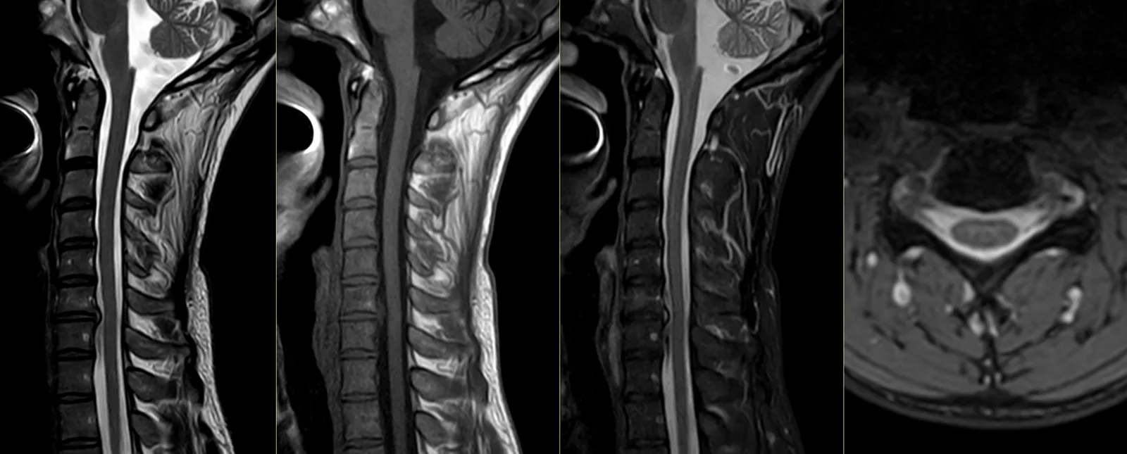 Ressonância magnética da coluna cervical: cortes sagitais e axial, com as vértebras cervicais, os discos intervertebrais, a medula espinhal e o canal vertebral.