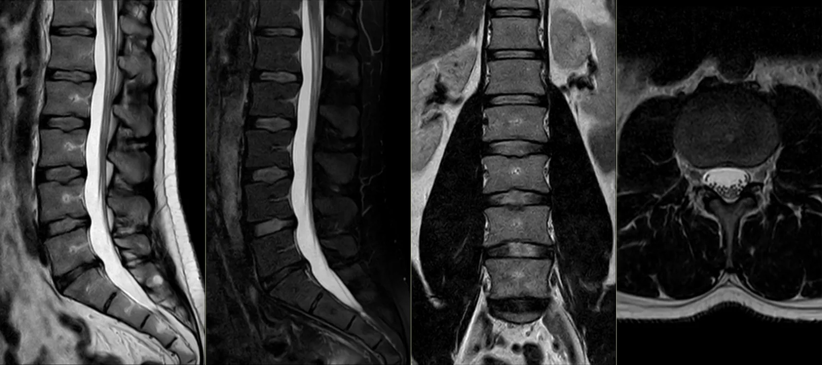 Ressonância magnética da coluna lombar: cortes sagitais, coronal e axial, com as vértebras, os discos intervertebrais, o canal vertebral e as raízes nervosas.
