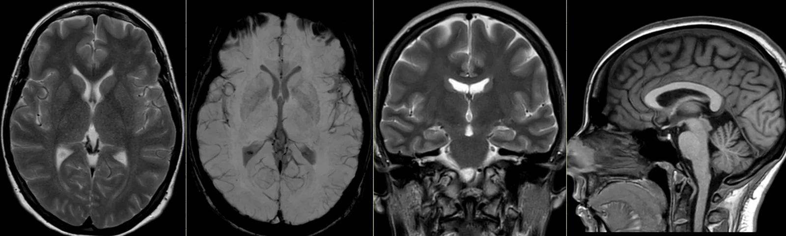 Ressonância magnética crânio-encefálica: cortes axiais, coronal e sagital do encéfalo, com o cérebro, o cerebelo, o tronco cerebral e os ventrículos.