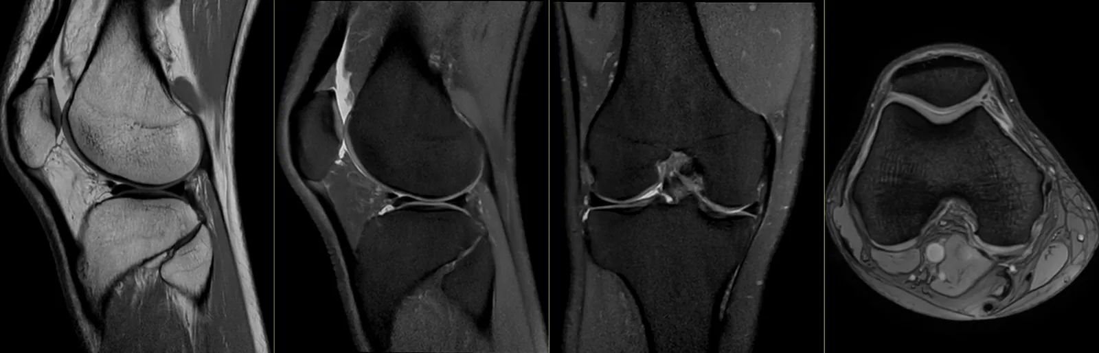 Ressonância magnética do joelho: cortes sagitais, coronal e axial, com os meniscos, os ligamentos cruzados, a cartilagem articular e as estruturas ósseas.