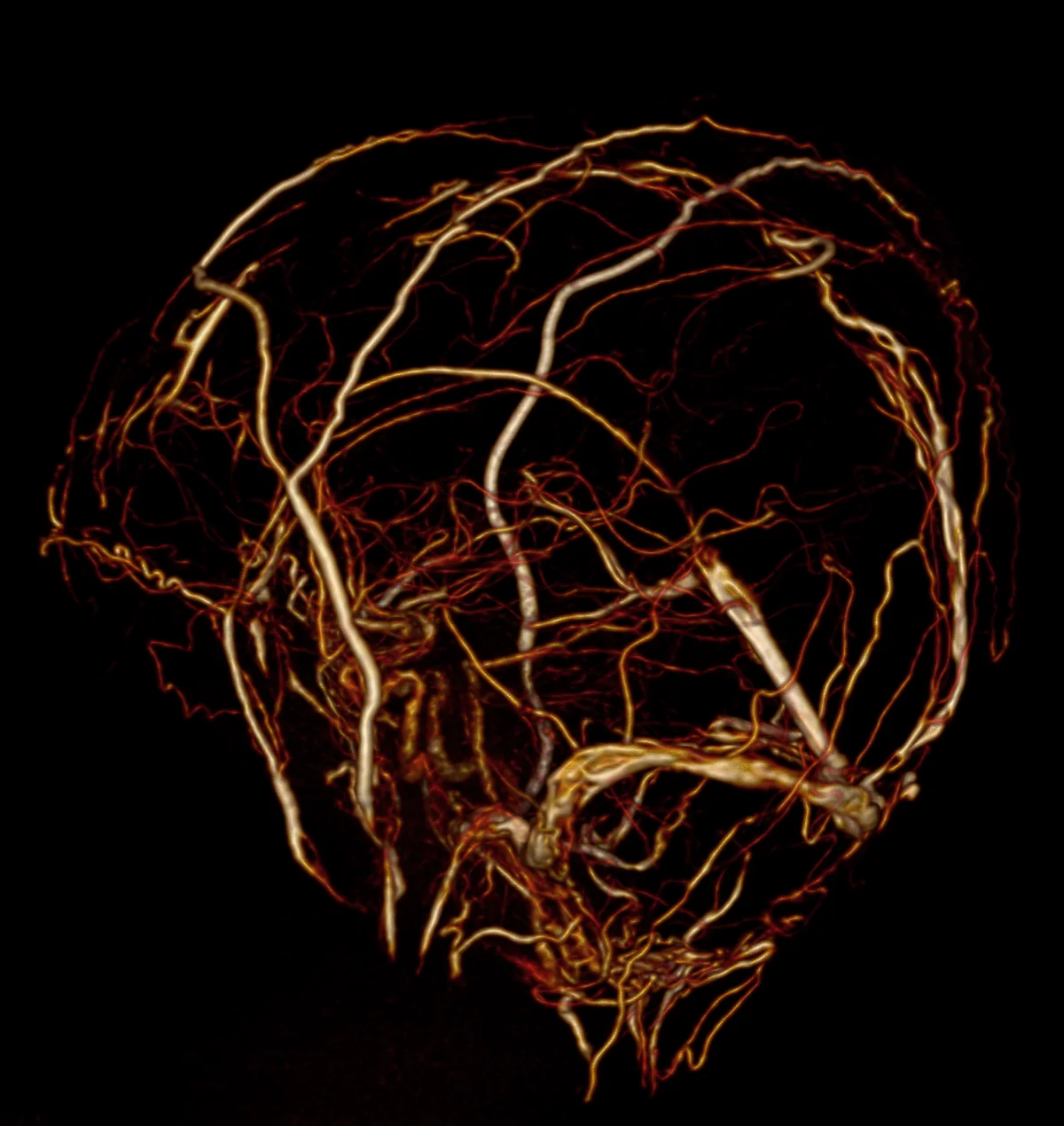 Reconstrução tridimensional dos vasos do cérebro obtida por angio-RM, com uma malformação arteriovenosa.