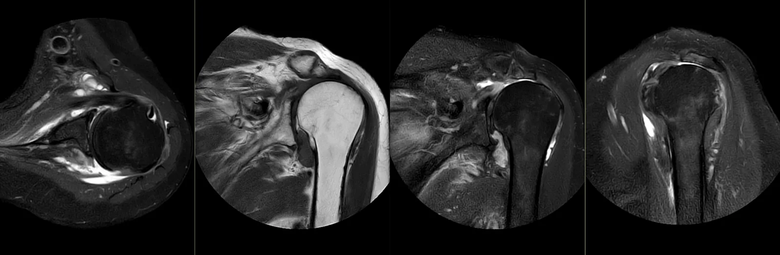 Ressonância magnética do ombro: cortes axial, coronais e sagital, com os tendões da coifa dos rotadores, o lábrum e a articulação do ombro.