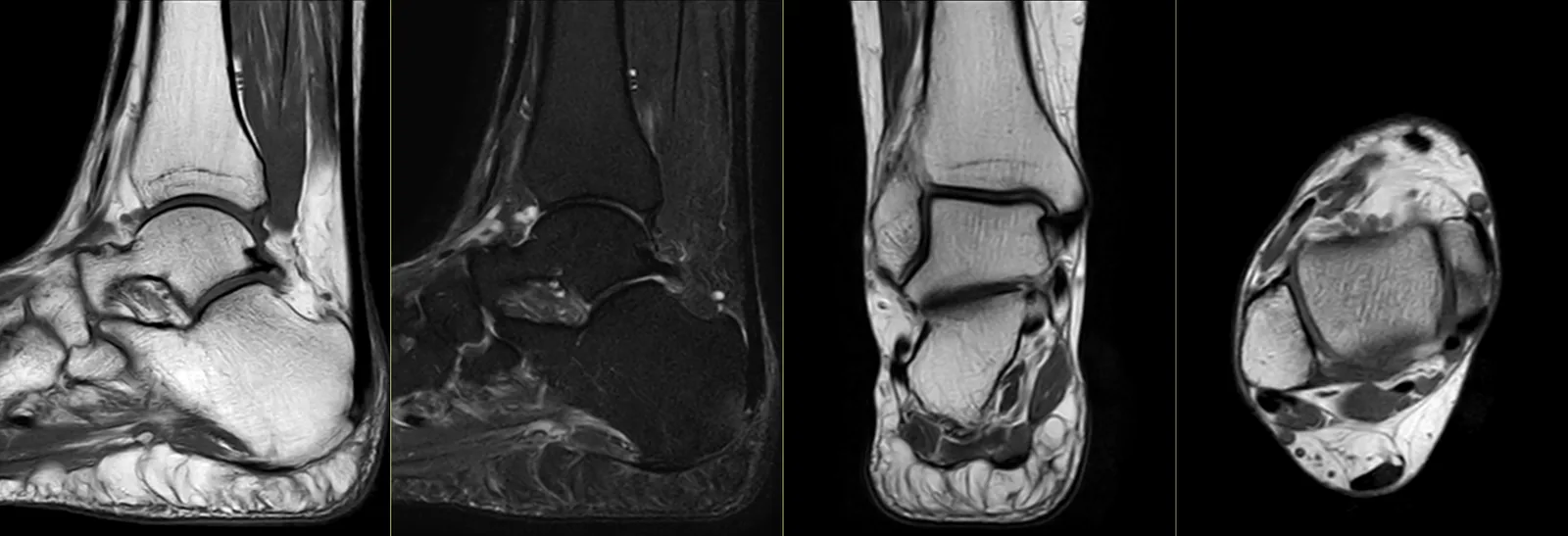 Ressonância magnética do pé e tornozelo: cortes sagitais, coronal e axial, com os ligamentos, os tendões, a cartilagem e as estruturas ósseas.