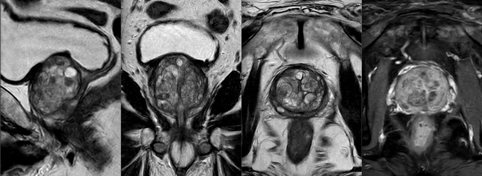 Ressonância magnética multiparamétrica da próstata: cortes sagital, coronal e axiais da glândula prostática e das vesículas seminais.