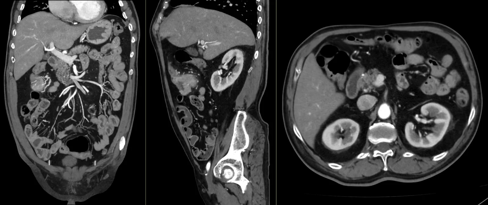 TC abdominal e pélvica: cortes coronal, sagital e axial do abdómen e da pélvis, com contraste iodado endovenoso a realçar o fígado, os rins e os vasos.