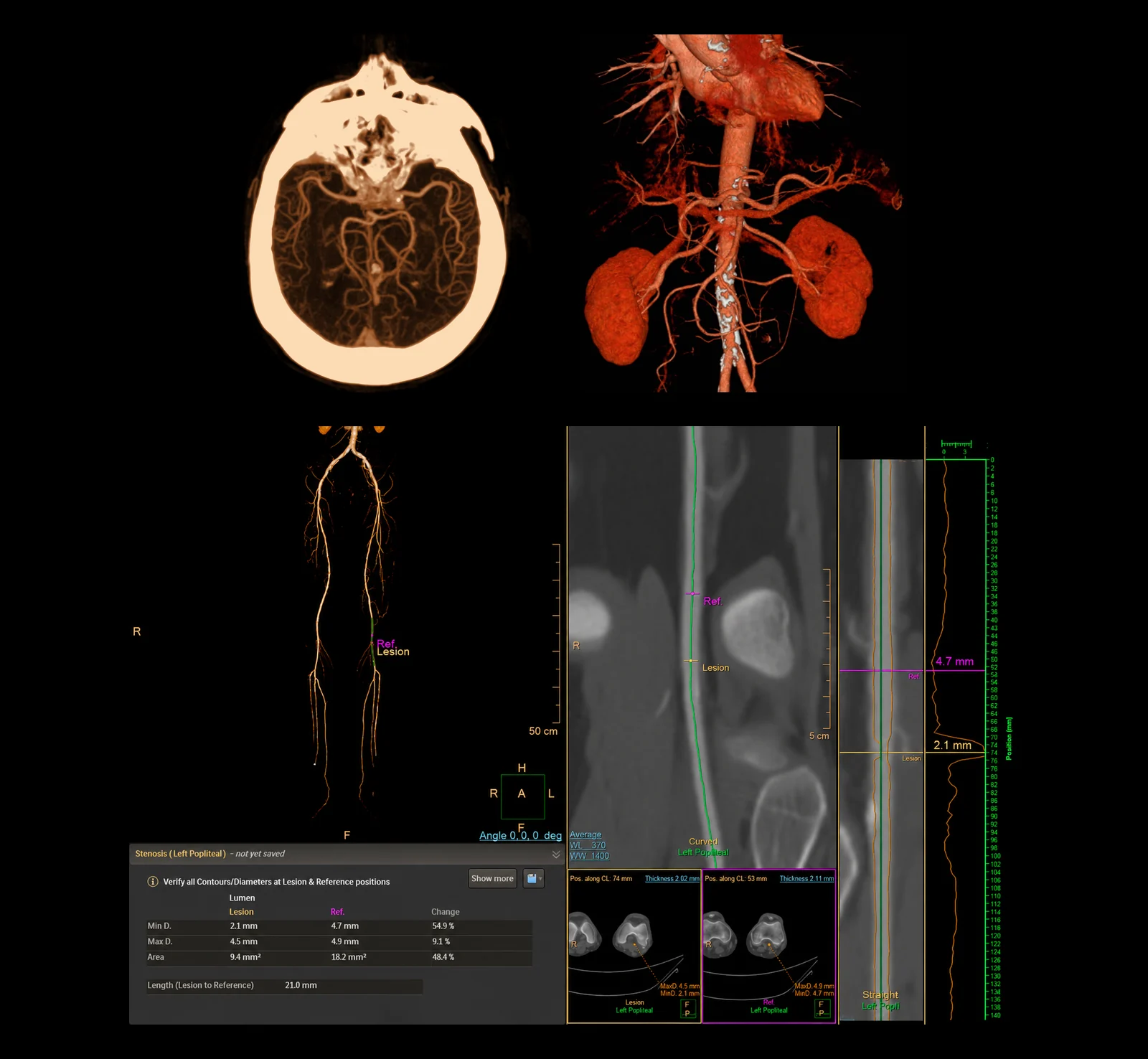 Angio-TC na CRMA: em cima, reconstruções tridimensionais dos vasos intracranianos e da aorta abdominal com as artérias renais; em baixo, o estudo arterial dos membros inferiores com as ferramentas de quantificação da estenose — diâmetros do lúmen, área e percentagem de redução.