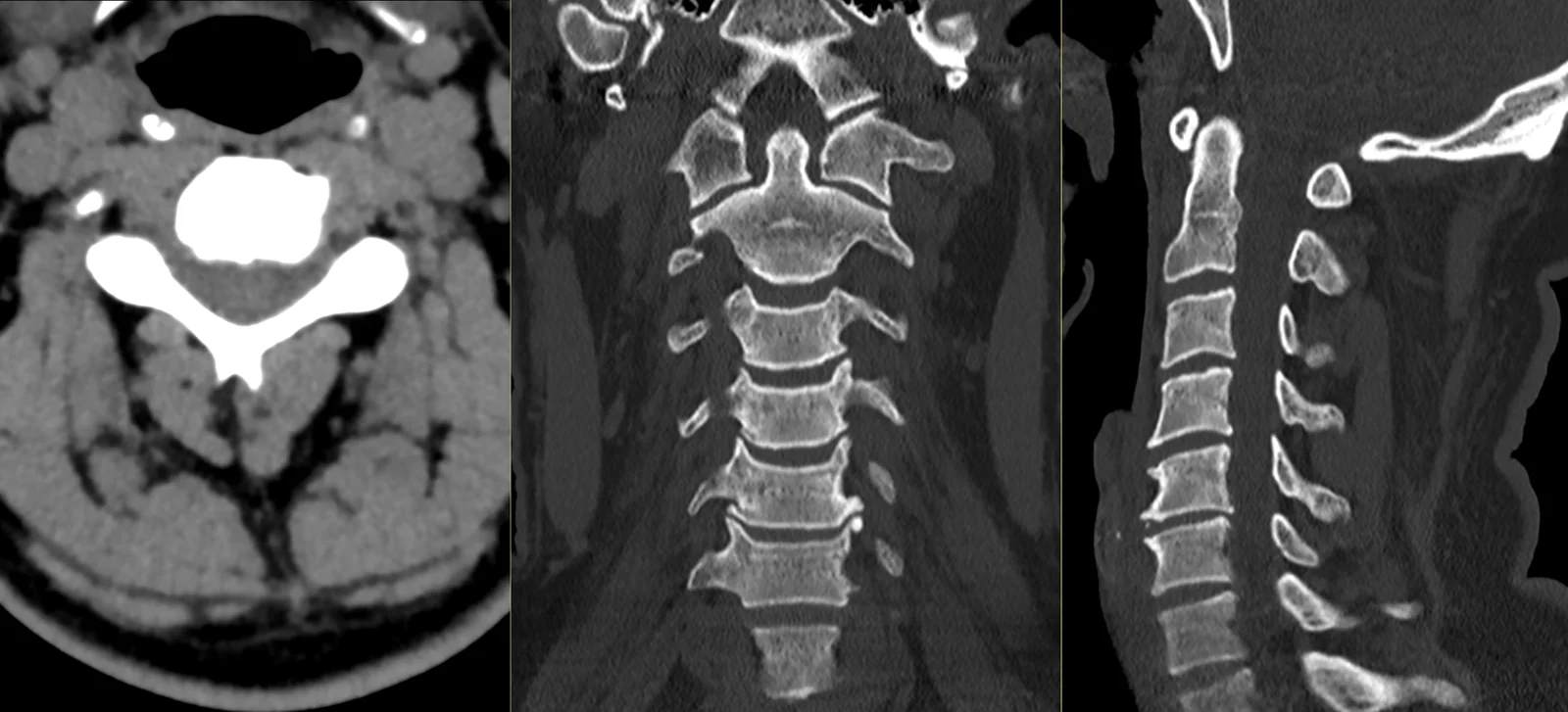 TC à coluna cervical: cortes axial, coronal e sagital das vértebras cervicais, em janela óssea.