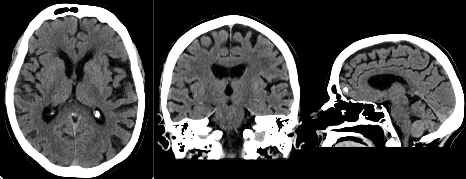 TC crânio-encefálica: cortes axial, coronal e sagital do encéfalo, em janela de tecidos moles.