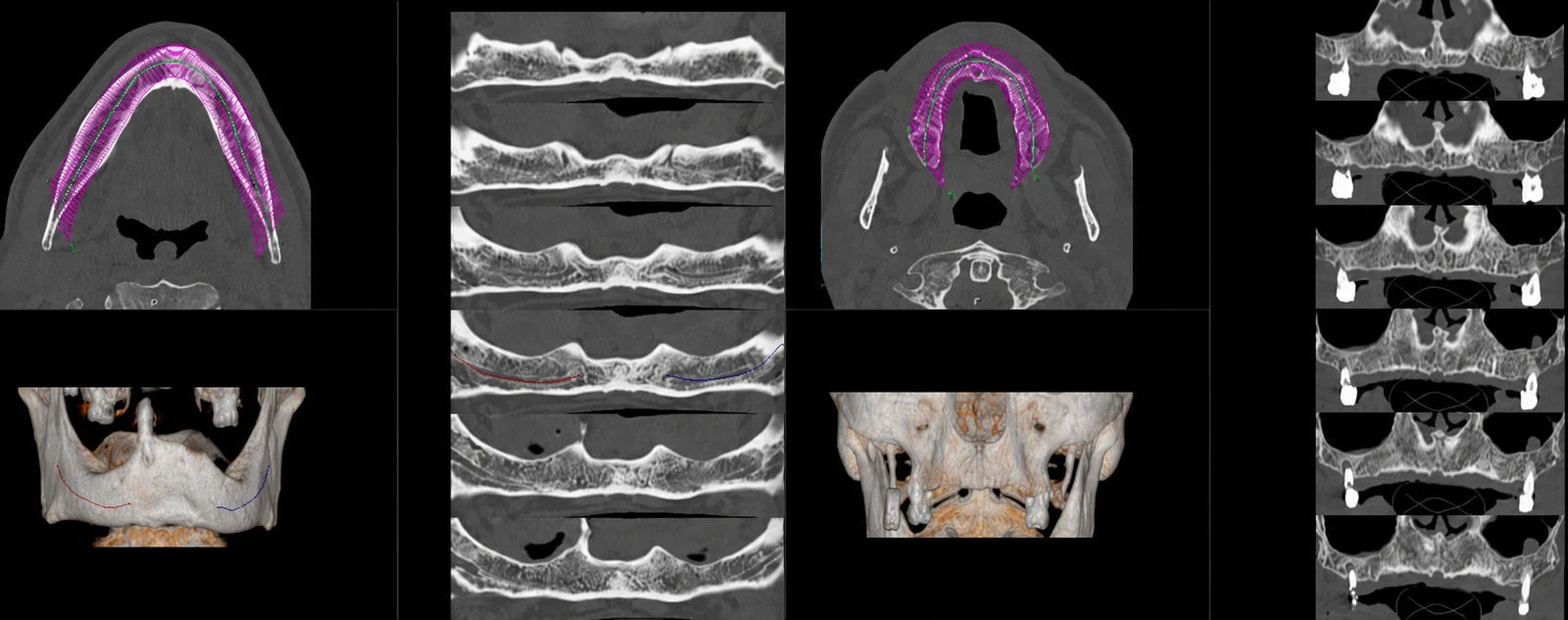 Dental scan por TC: reconstruções da mandíbula e da maxila com cortes transversais e marcação do trajeto do canal dentário.