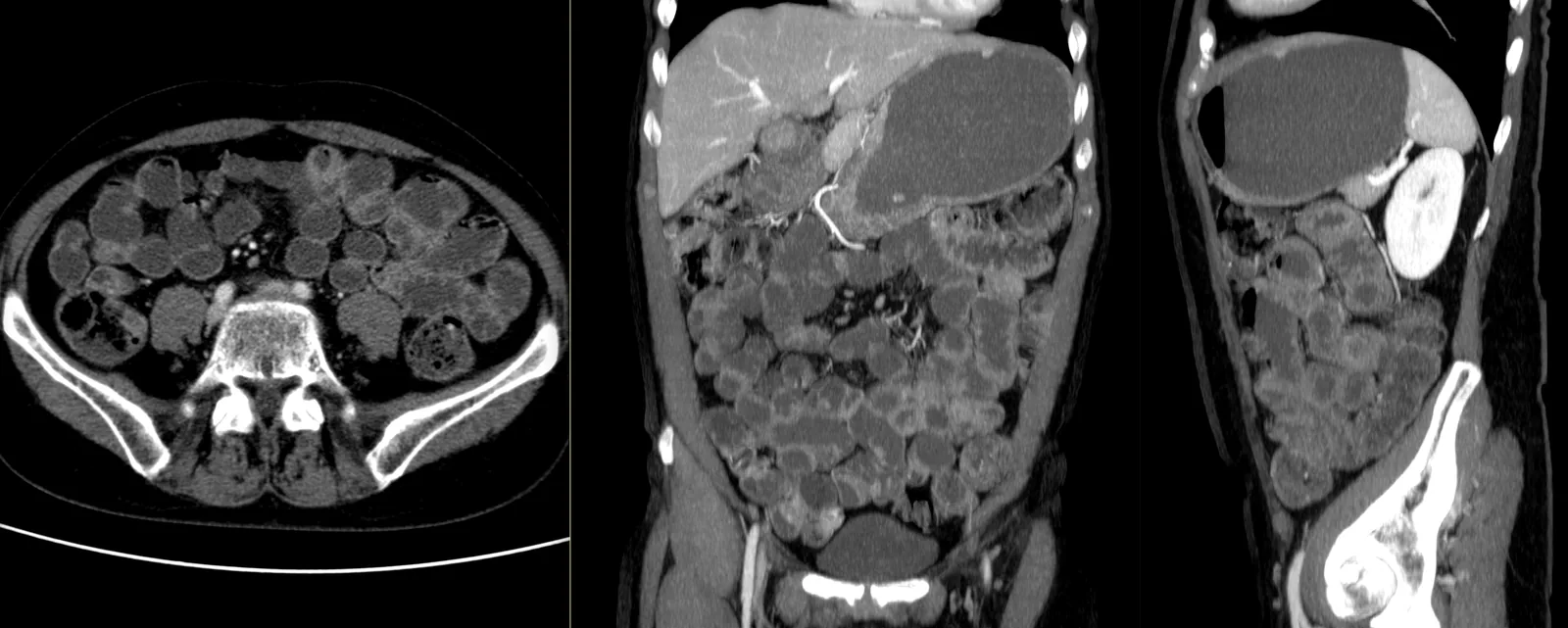 Enterografia por TC: cortes axial, coronal e sagital do abdómen com as ansas do intestino delgado distendidas pelo contraste oral e realçadas pelo contraste iodado endovenoso.