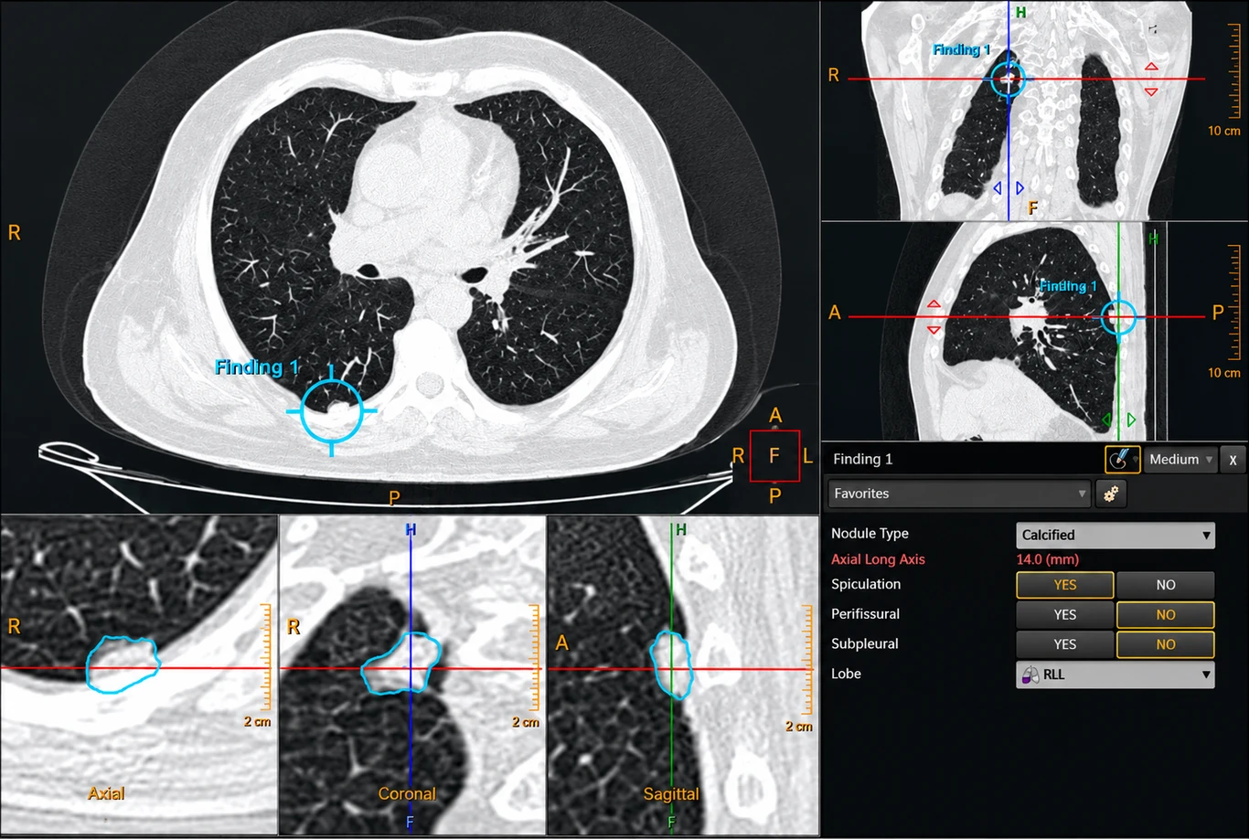 Caracterização de um nódulo pulmonar numa TC ao tórax, com contorno automático e vistas axial, coronal e sagital e medição do eixo maior.