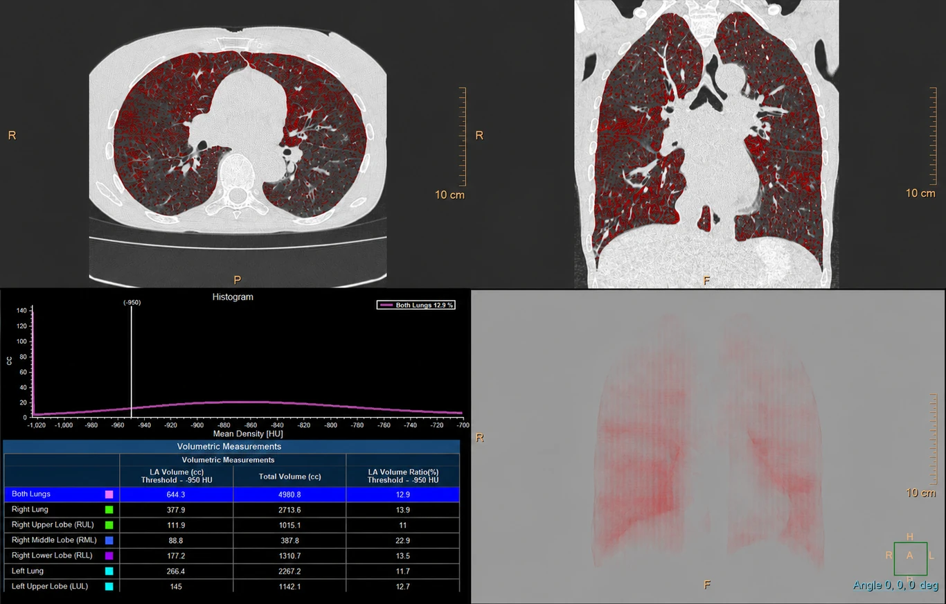 Análise volumétrica numa TC ao tórax: as áreas de baixa densidade (enfisema) surgem realçadas a vermelho nos cortes axial e coronal, com histograma e medições por pulmão e por lobo.