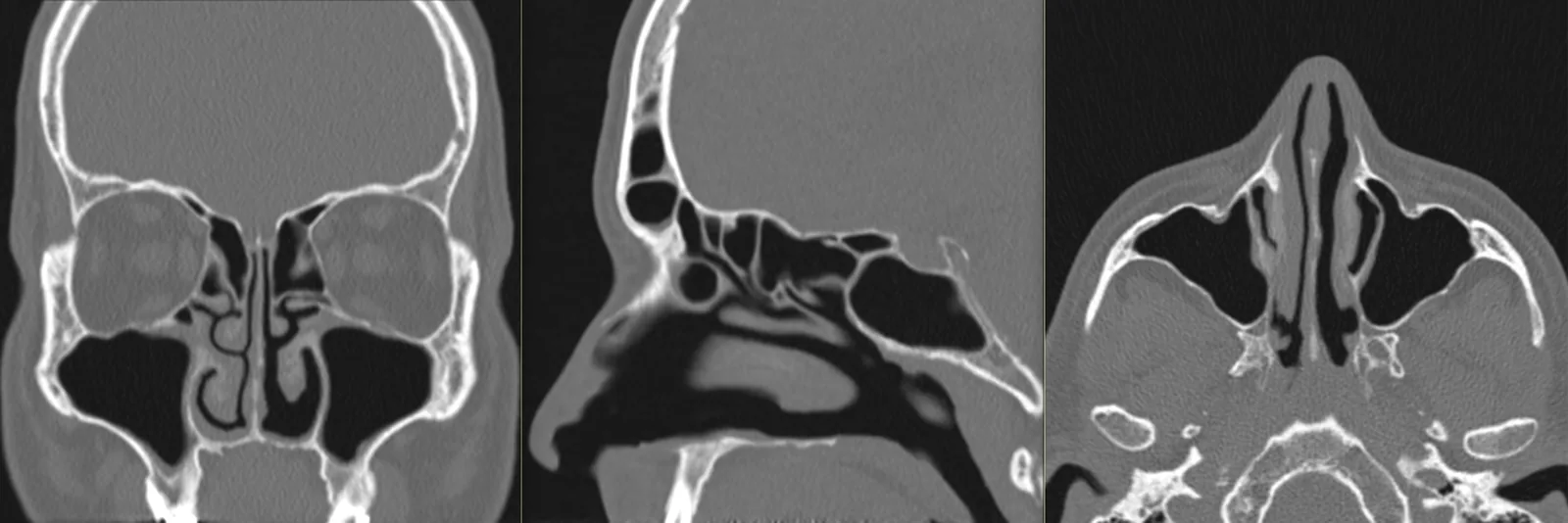 Sinus CT scan: axial, coronal and sagittal slices of the paranasal sinuses, in a bone window.