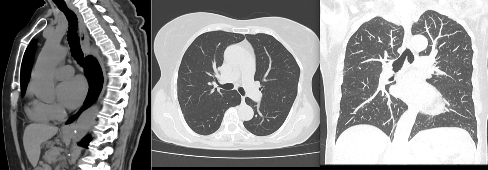 TC ao tórax: cortes sagital, axial e coronal — janela de pulmão a mostrar o parênquima pulmonar, com o mediastino e a aorta torácica.