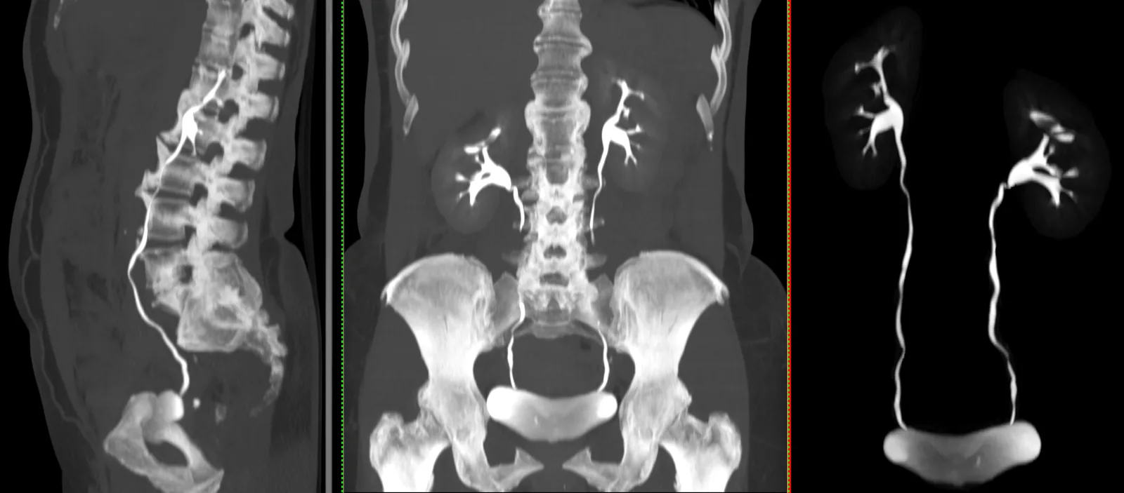 Uro-CT: reconstructions of the urinary tract with contrast outlining the kidneys, the ureters and the bladder, in a sagittal slice and a coronal projection.